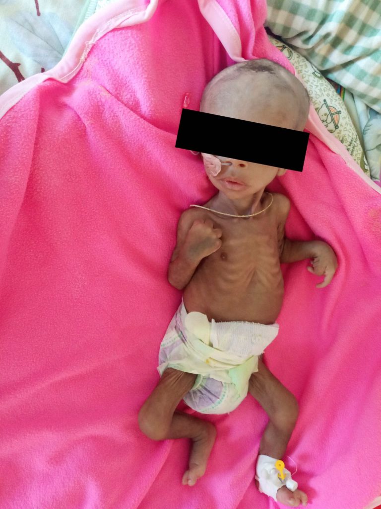 Surafeal Mearig di 3 mesi malnutrito, che pesa 2.3 kg rispetto al suo peso alla nascita di 3.4 kg, si prende cura di essere stato ricoverato all’Ayder Referral Hospital di Mekelle, regione del Tigray, Etiopia, 22 dicembre 2021. REUTERS/Stringer