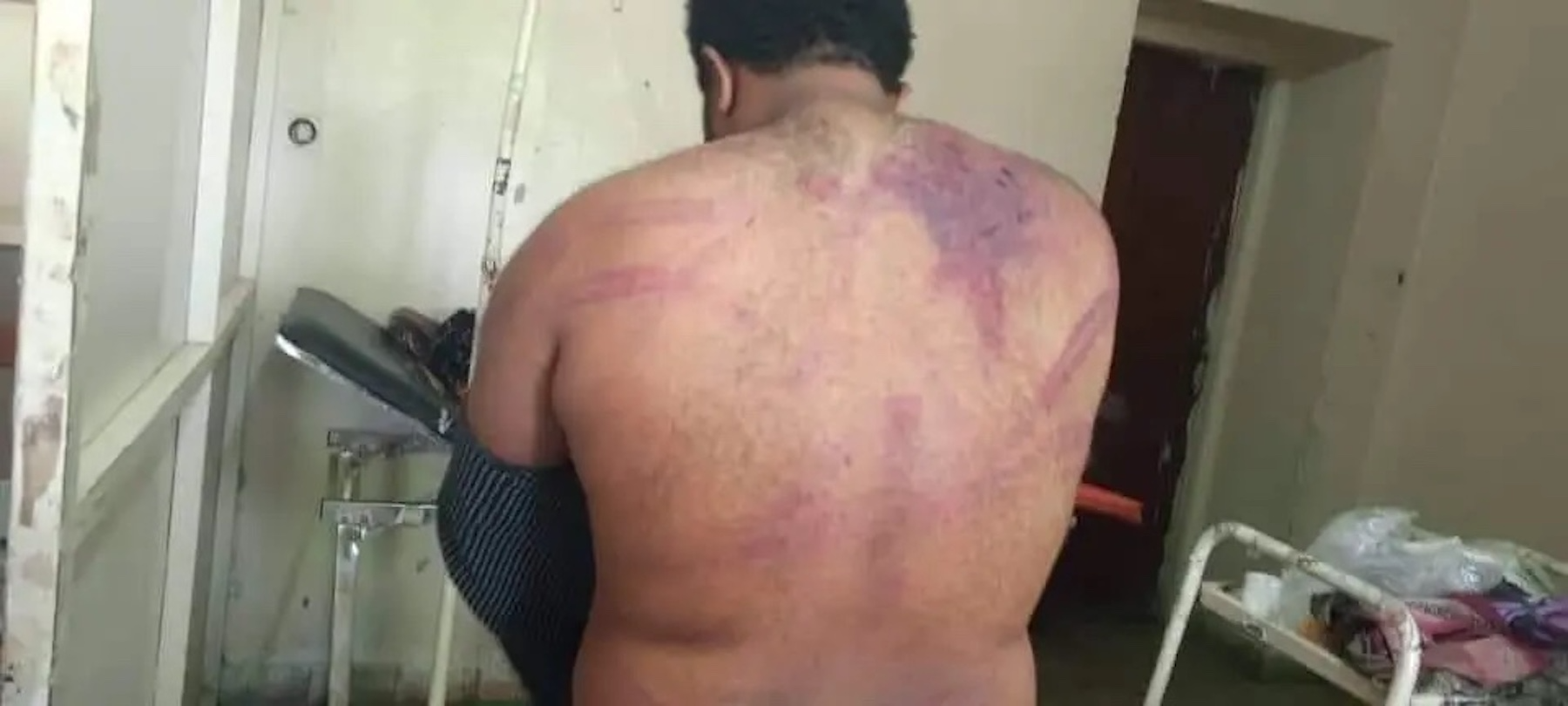 il corpo del giornalista Teshager Tsigab torturato dalla polizia.