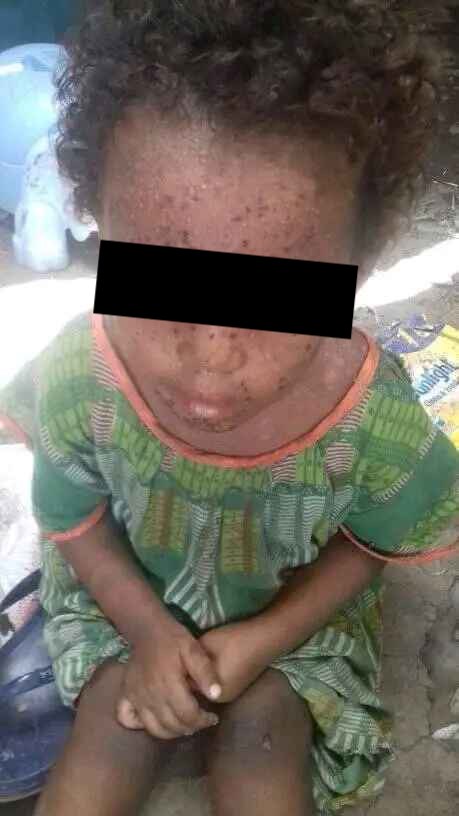 Condizioni cutanee di una bambina tigrina detenuta nel campo di Semera – Afar senza supporto medico