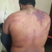 il corpo del giornalista Teshager Tsigab torturato dalla polizia.